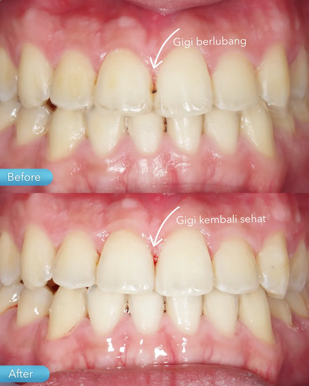 Dental filling result
